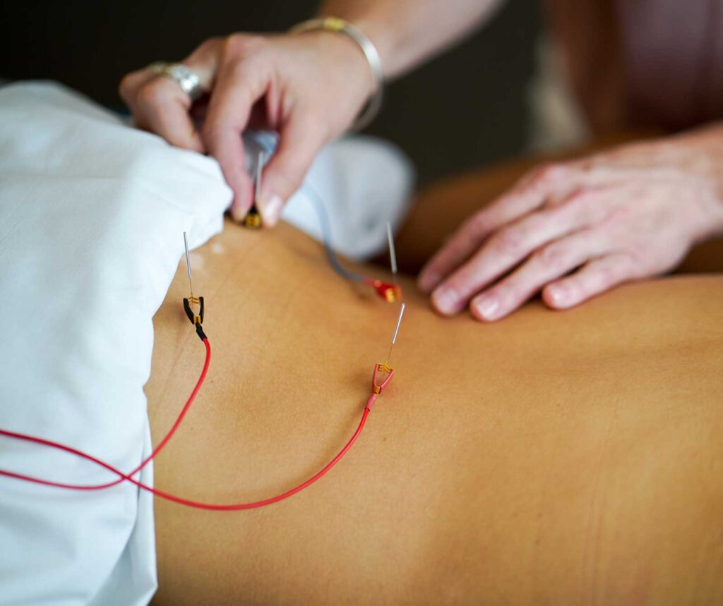 Woman getting acupuncture for IVF | IVF Acupuncture | IUI Acupuncture in Boulder & Longmont | Well Woman