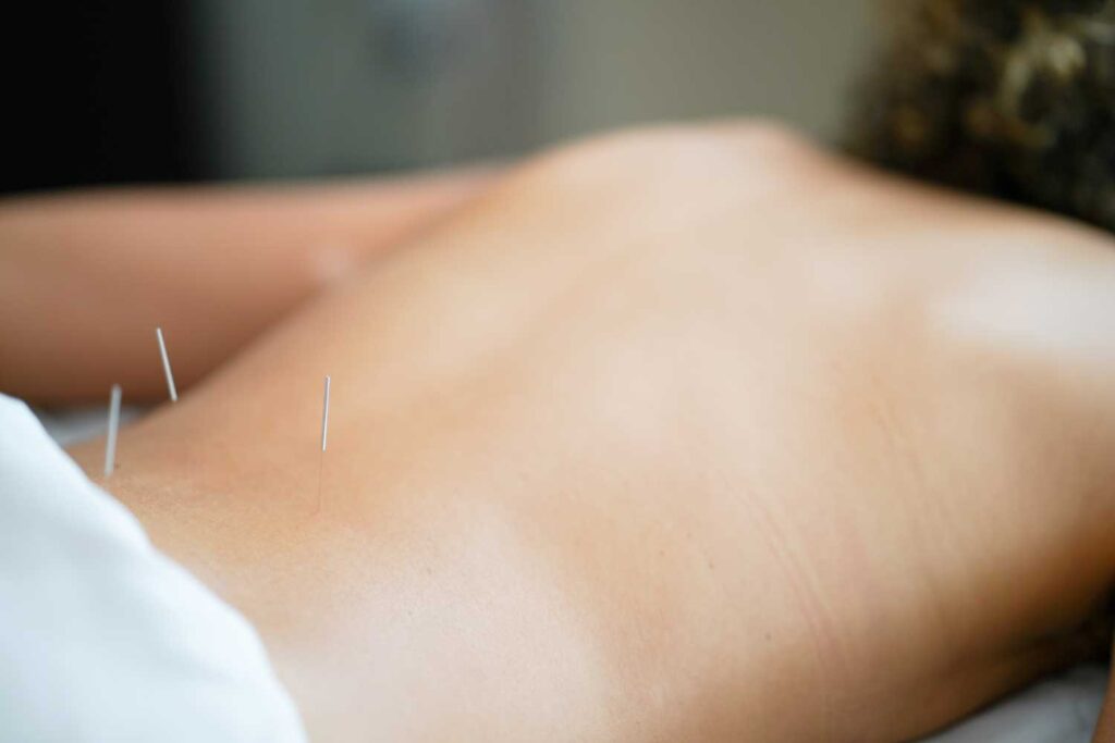 Acupuncture needles in back Traditional Chinese-Style Acupuncture Services | Boulder & Longmont