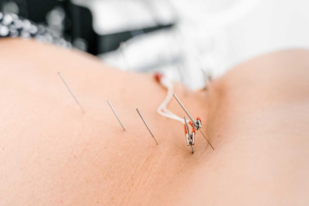 Acupuncture needles e-stim | Traditional Chinese-Style Acupuncture Services | Boulder & Longmont